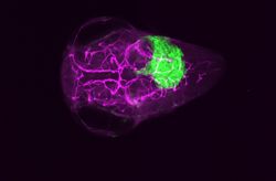 MAP4 kinases in medulloblastoma dissemination