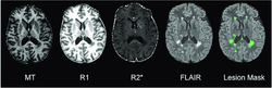 Master thesis: MRI study to investigate changes in Migraine and Epilepsy patients